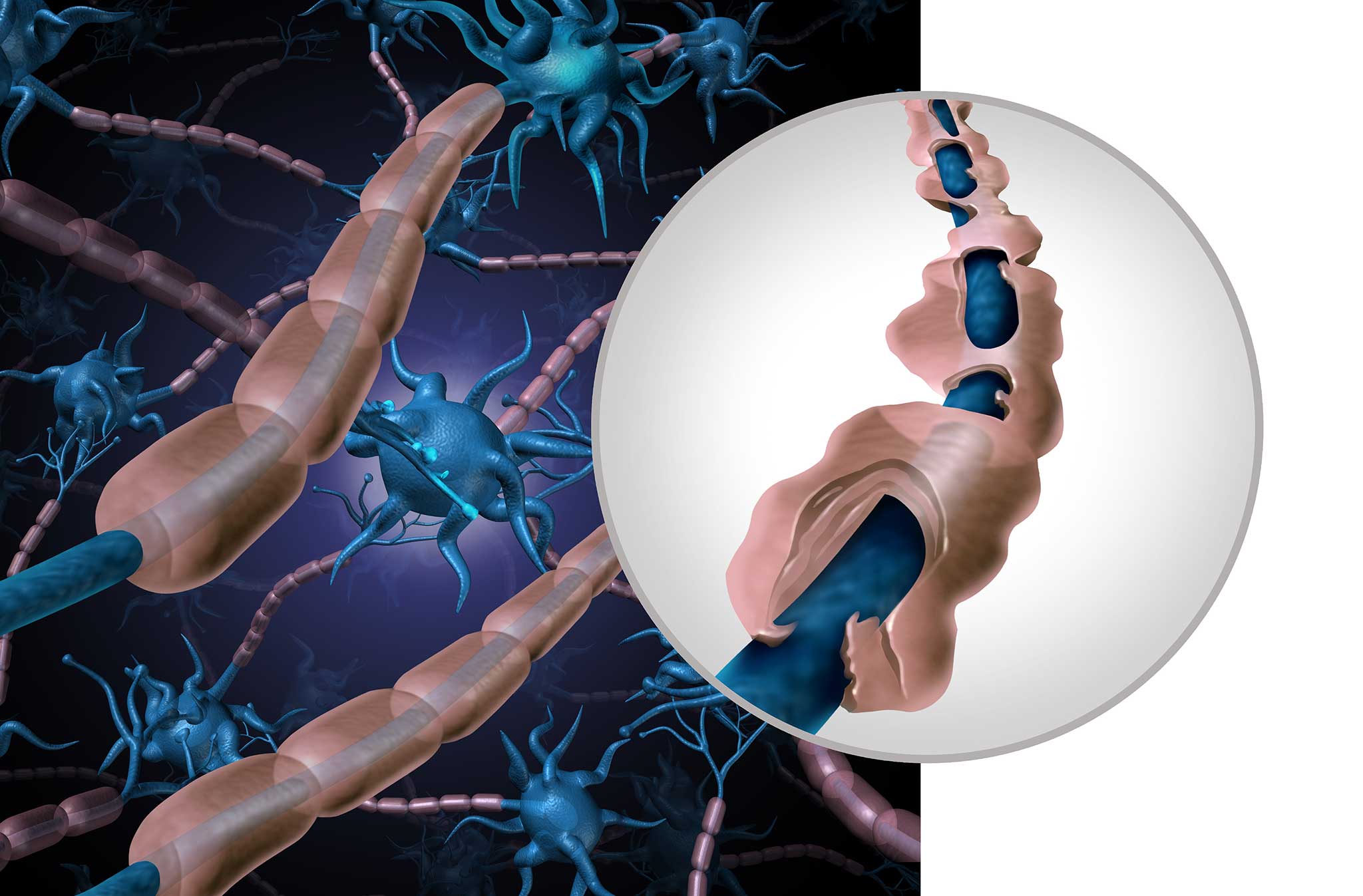 Illustration von Nervenzellen mit einer Nahaufnahme, die eine beschädigte Myelinscheide an einem Axon zeigt, was eine Nervendegeneration darstellt. Ideal für Forschung oder MS-Studien. Der Hintergrund zeigt blaue Neuronen, und der geschädigte Bereich ist in einem kreisförmigen Rahmen hervorgehoben.
